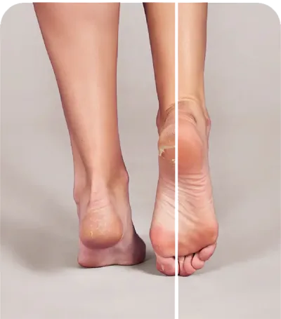 FOOT3-400×455 Сравнение на външния вид на суха и гладка пета